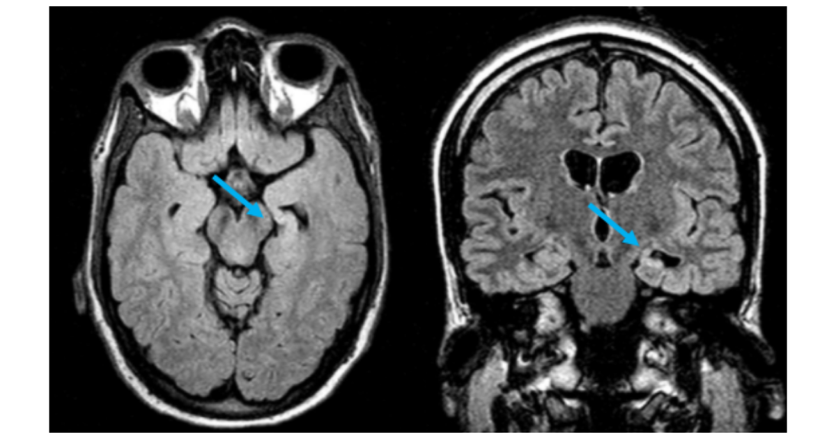 What Is Mesial Temporal Sclerosis? | MTS Symptoms